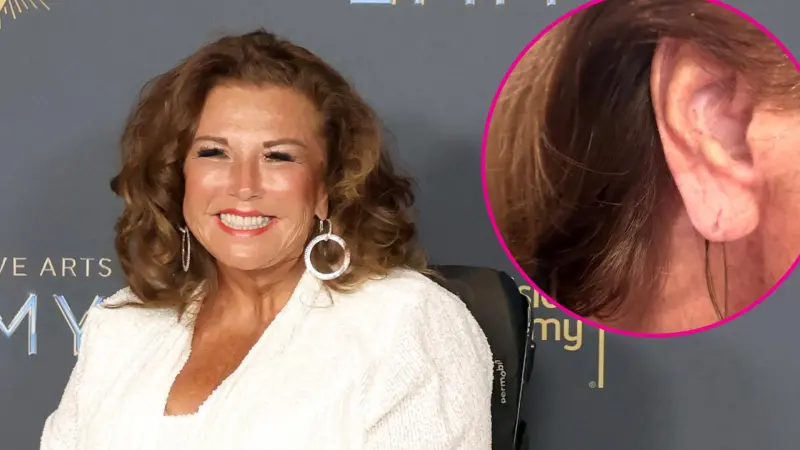 Abby Lee Miller Flashes Results of $1K Earlobe Rejuvenation: ‘It Was Amazing’